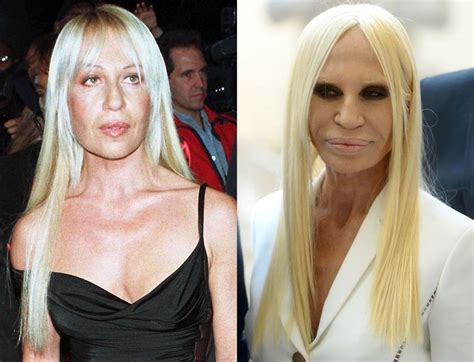 donatella versace before and after plastic surgery